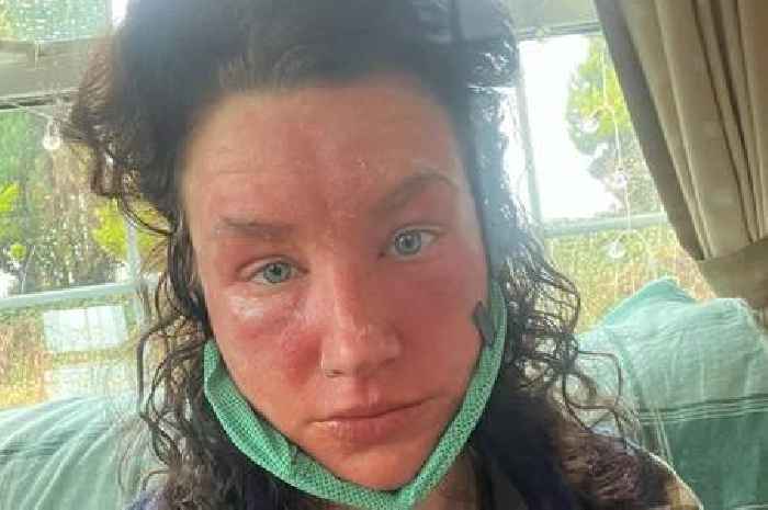 Woman who had 'small rash' now 'looks like she's burnt' after reaction