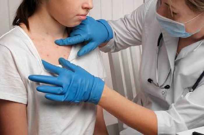 Measles outbreak kills child as UK health officials warn it 'could spread like wildfire'