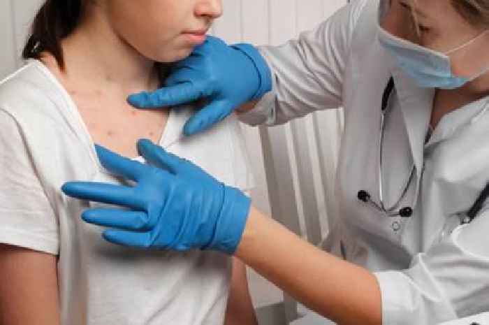 Child with measles dies in hospital as experts fear virus 'could spread like wildfire'