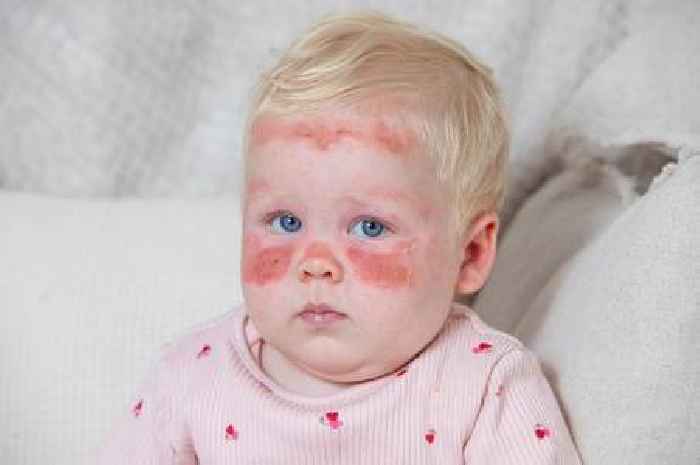 Baby suffers severe sunburn - despite being covered in factor 50 cream