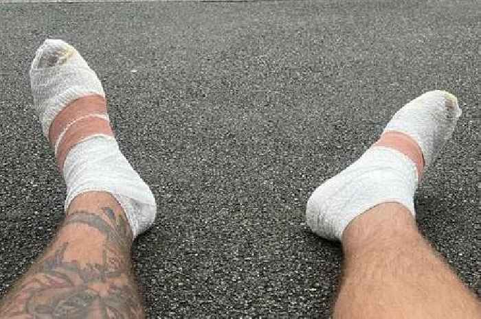 Charity fundraiser ends up in hospital after tearing all the skin off his feet in horror challenge
