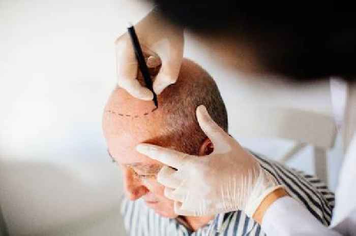 Brit dies after hair transplant in Turkey