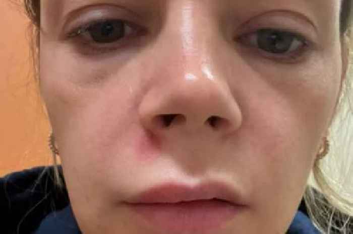 Mum hospitalised squeezing spot on 'triangle of death' area of face