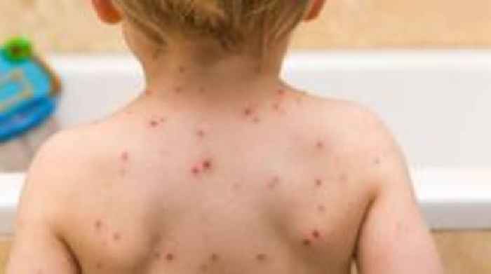 Children to be offered chickenpox vaccine on NHS