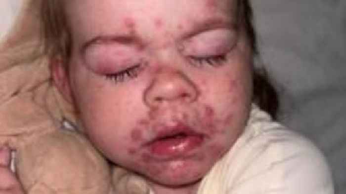 Children offered chickenpox vaccine on NHS
