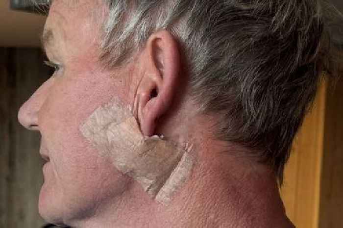 Skin cancer warning signs as Gordon Ramsay issues message after diagnosis