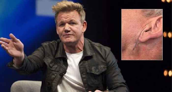 Gordon Ramsay Shares Surgery Scar as He Reveals Skin Cancer Diagnosis: ‘Don’t Forget Your Sunscreen’