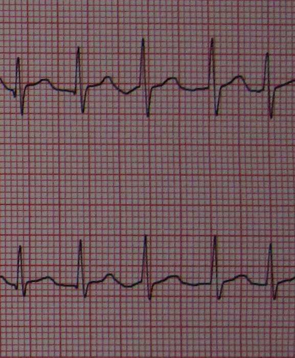 Work-Related Stress May Increase Risk Of Irregular Heart Rhythm