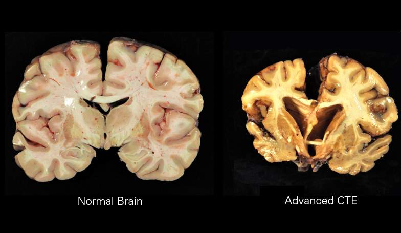 What is CTE? The degenerative brain disease that's been found in NFL players, explained