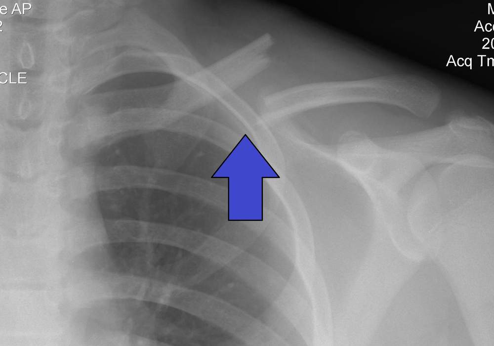Clavicle fracture