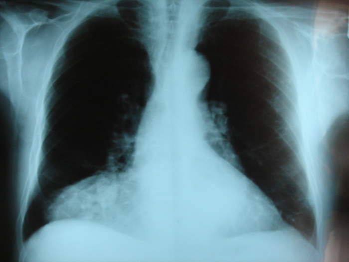 Congenital diaphragmatic hernia