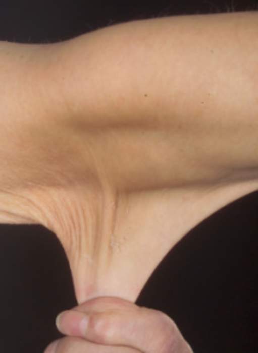 Ehlers–Danlos syndrome