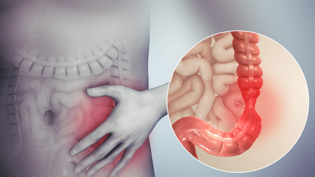 Cancer: Woman's condition incurable after IBS misdiagnosis
