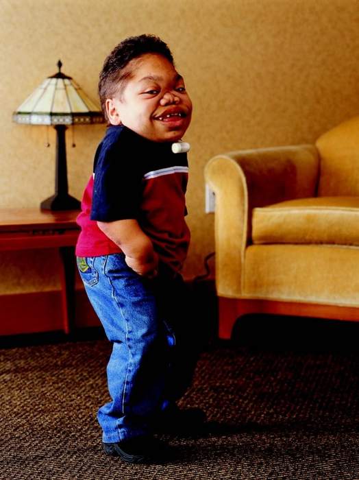 Mucopolysaccharidosis