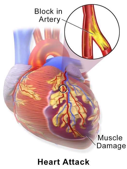 Myocardial Infarction Facts And News Updates One News Page