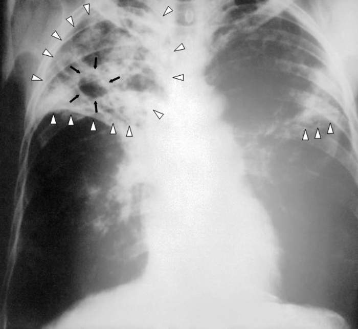 CDI Scientists ID ‘Unconventional’ New Pathway For TB Vaccines