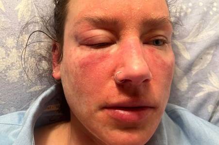 My skin is constantly on fire and I look like a burns victim because of a common cream, this might last years